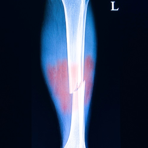 Röntgenaufnahme eines gebrochenen Unterschenkels