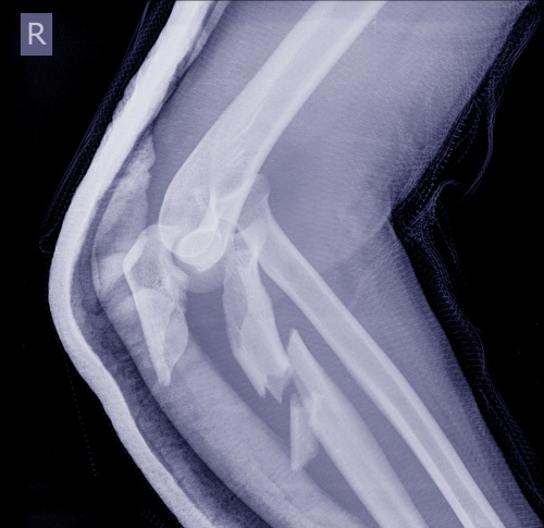 Röntgenaufnahme einer Unterschenkelfraktur